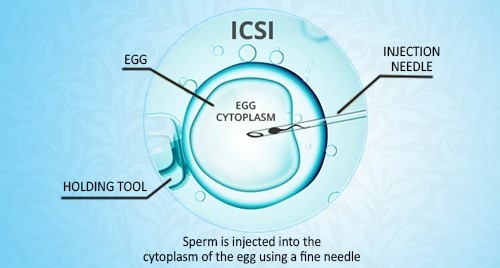 how does icsi treatment work