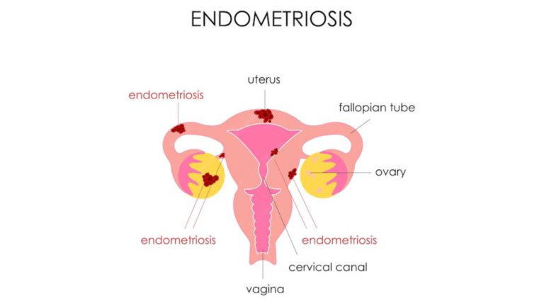 Endometriosis