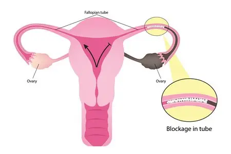 Blocked Fallopian Tubes