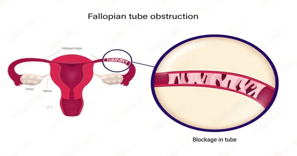 IVF Treatment