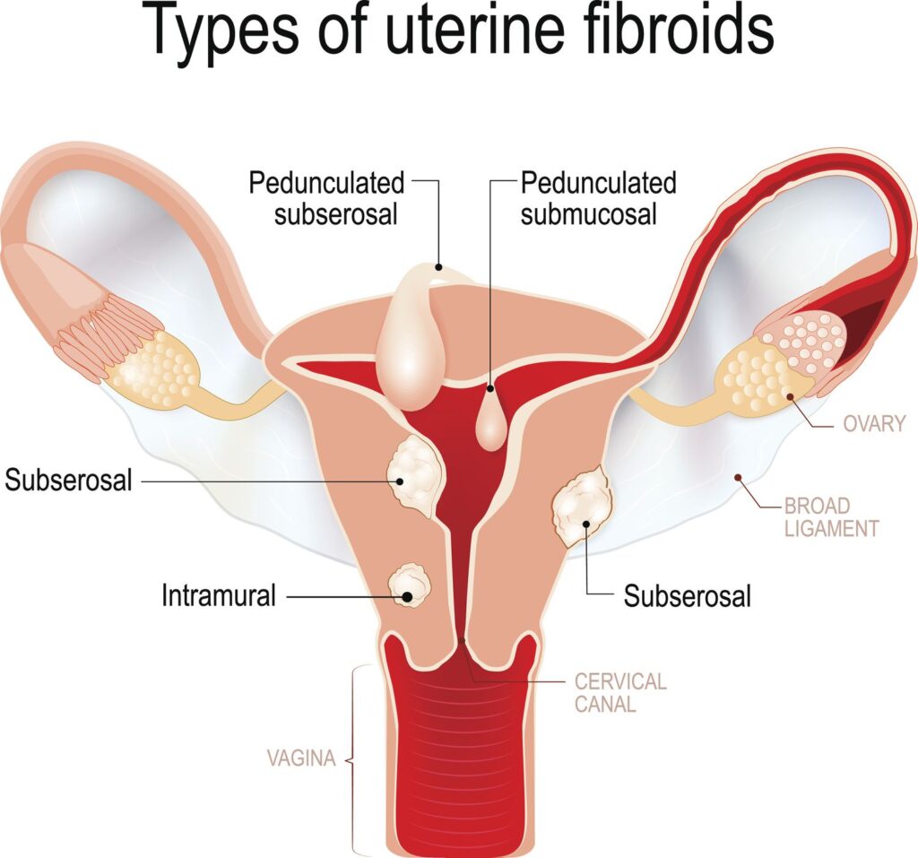 Uterine Fibroids and Pregnancy