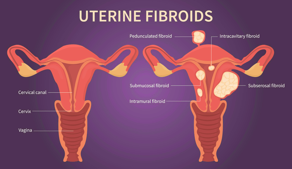 Uterine Fibroids and Pregnancy